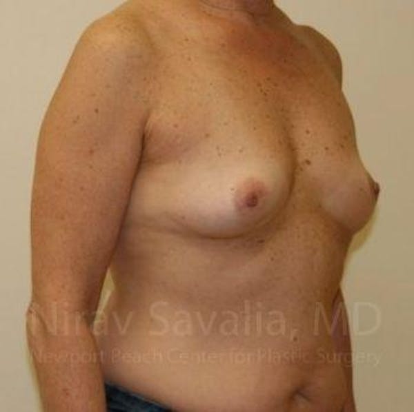 Breast Explantation En Bloc Capsulectomy Before & After Gallery - Patient 1655519 - Before