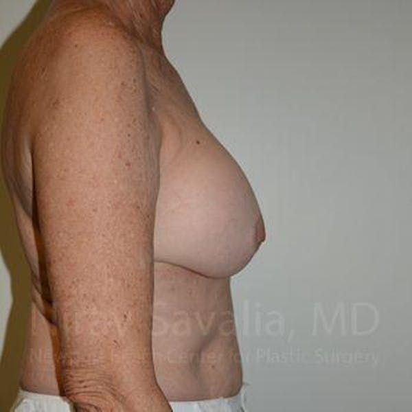 Breast Lift with Implants Before & After Gallery - Patient 1655520 - Before
