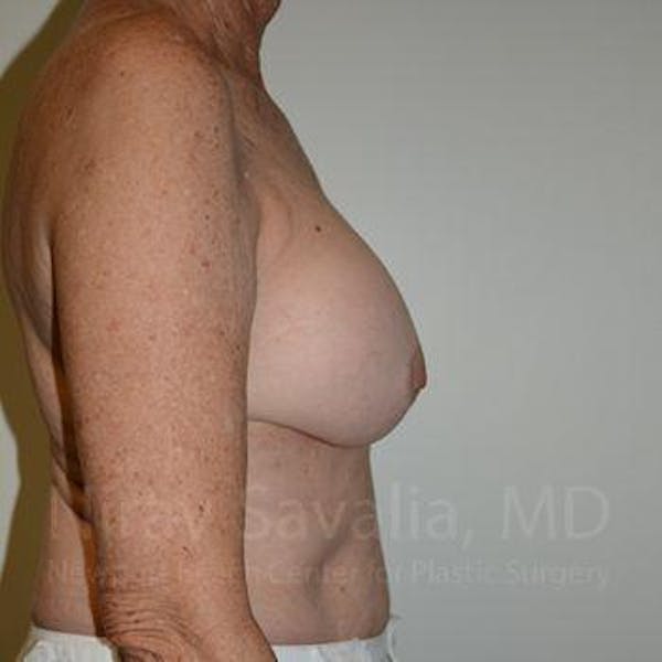 Breast Explantation En Bloc Capsulectomy Before & After Gallery - Patient 1655520 - Before