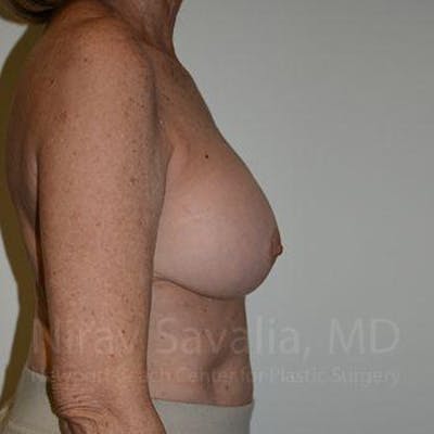 Breast Explantation En Bloc Capsulectomy Before & After Gallery - Patient 1655520 - After