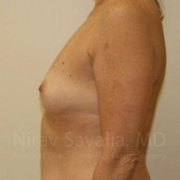 Breast Explantation En Bloc Capsulectomy Before & After Gallery - Patient 1655519 - Before