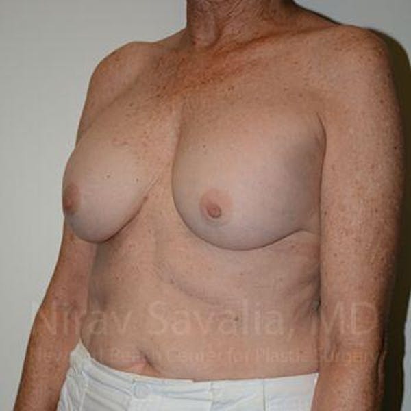 Breast Explantation En Bloc Capsulectomy Before & After Gallery - Patient 1655520 - Before