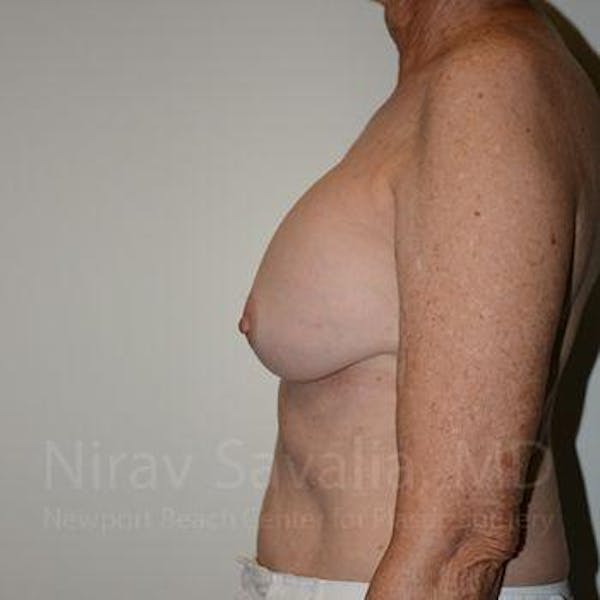 Breast Explantation En Bloc Capsulectomy Before & After Gallery - Patient 1655520 - Before