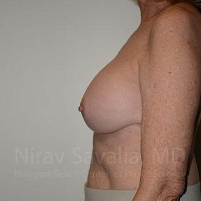 Breast Lift with Implants Before & After Gallery - Patient 1655520 - After