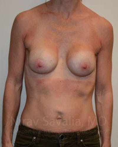 Breast Explantation En Bloc Capsulectomy Before & After Gallery - Patient 1655536 - Before