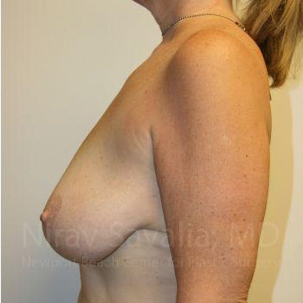 Oncoplastic Reconstruction Before & After Gallery - Patient 1655534 - Before