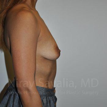 Chin Implants Before & After Gallery - Patient 1655537 - Before