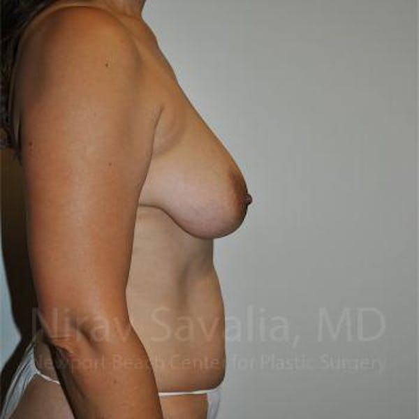 Oncoplastic Reconstruction Before & After Gallery - Patient 1655542 - Before