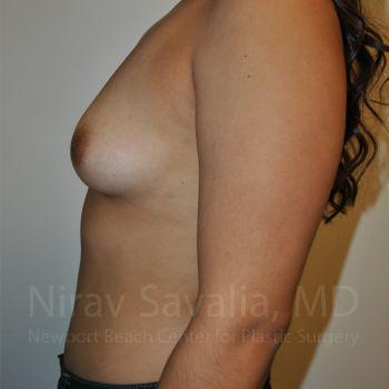 Chin Implants Before & After Gallery - Patient 1655544 - Before