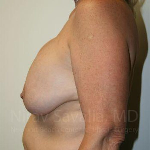 Breast Lift with Implants Before & After Gallery - Patient 1655545 - Before