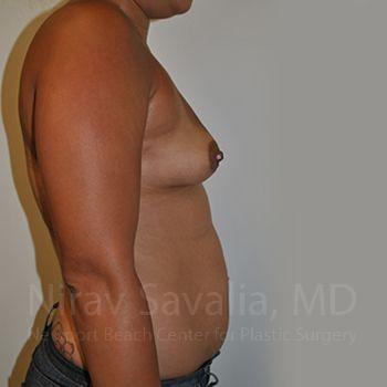 Oncoplastic Reconstruction Before & After Gallery - Patient 1655546 - Before