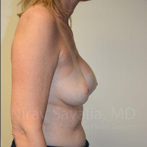 Liposuction Before & After Gallery - Patient 1655547 - Before