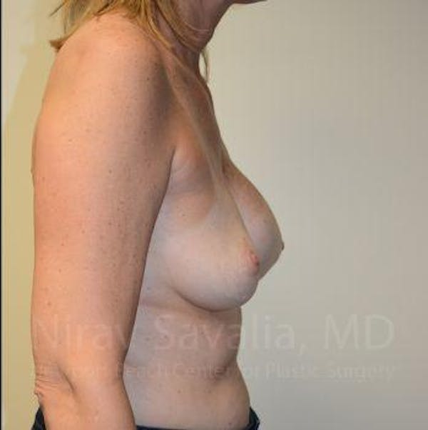 Breast Reduction Before & After Gallery - Patient 1655547 - Before