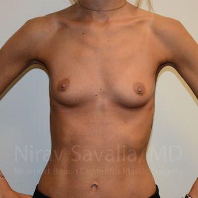 Breast Lift without Implants Before & After Gallery - Patient 1655548 - Before