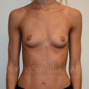 Thigh Lift Before & After Gallery - Patient 1655548 - Before