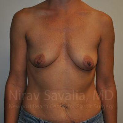 Oncoplastic Reconstruction Before & After Gallery - Patient 1655550 - Before