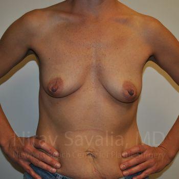 Abdominoplasty Tummy Tuck Before & After Gallery - Patient 1655550 - Before