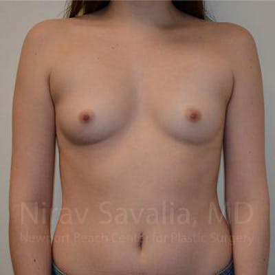 Breast Reduction Before & After Gallery - Patient 1655555 - Before