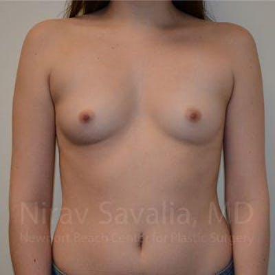 Oncoplastic Reconstruction Before & After Gallery - Patient 1655555 - Before