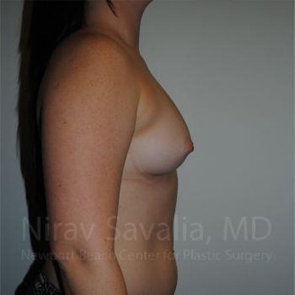 Chin Implants Before & After Gallery - Patient 1655559 - Before