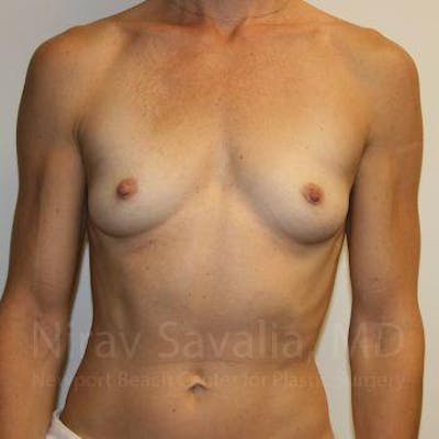 Chin Implants Before & After Gallery - Patient 1655561 - Before