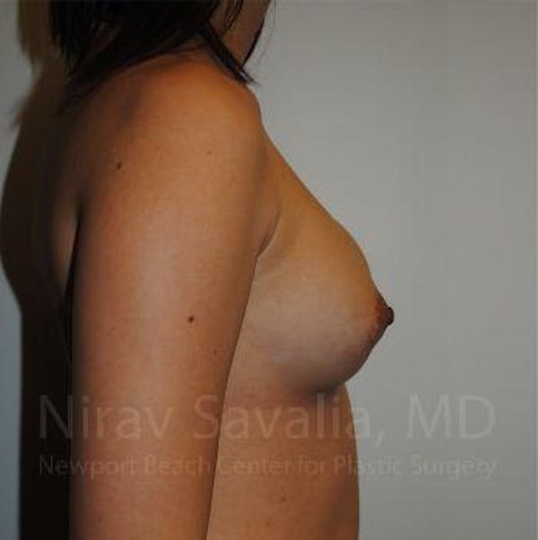 Breast Lift with Implants Before & After Gallery - Patient 1655564 - Before