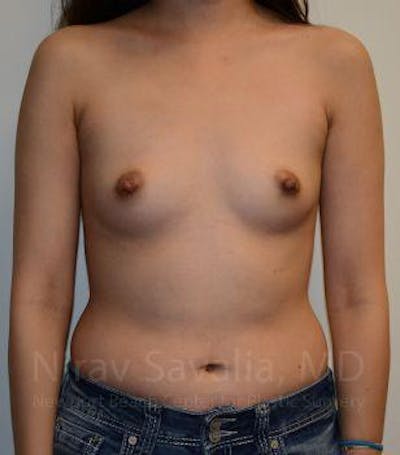 Breast Explantation En Bloc Capsulectomy Before & After Gallery - Patient 1655566 - Before
