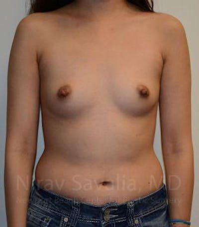 Breast Reduction Before & After Gallery - Patient 1655566 - Before