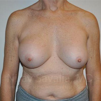 Breast Explantation En Bloc Capsulectomy Before & After Gallery - Patient 1655567 - Before