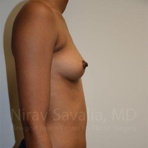 Chin Implants Before & After Gallery - Patient 1655568 - Before