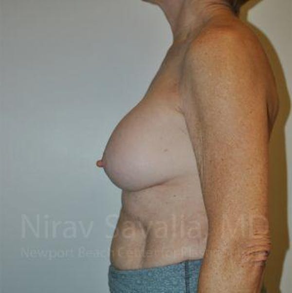 Breast Explantation En Bloc Capsulectomy Before & After Gallery - Patient 1655567 - Before