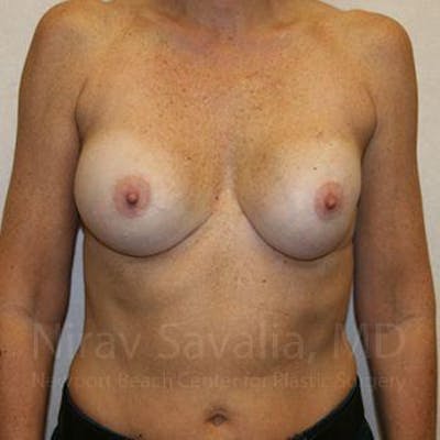 Breast Lift with Implants Before & After Gallery - Patient 1655570 - Before