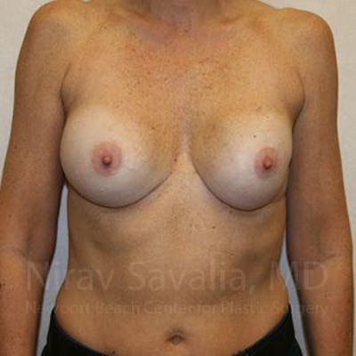 Breast Explantation En Bloc Capsulectomy Before & After Gallery - Patient 1655570 - Before