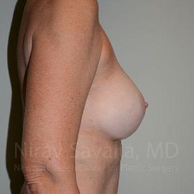 Oncoplastic Reconstruction Before & After Gallery - Patient 1655570 - After