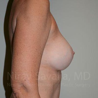 Mommy Makeover Before & After Gallery - Patient 1655570 - After