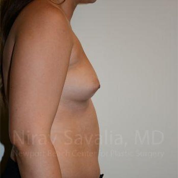 Breast Explantation En Bloc Capsulectomy Before & After Gallery - Patient 1655571 - Before