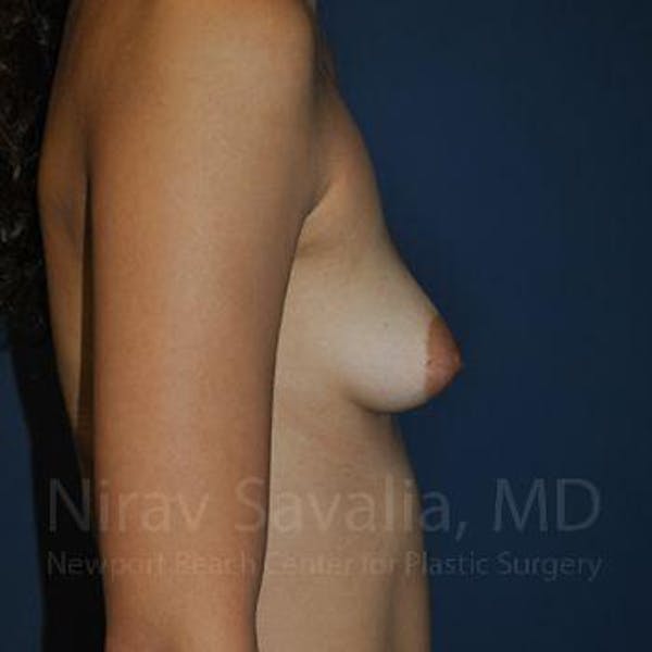 Oncoplastic Reconstruction Before & After Gallery - Patient 1655573 - Before