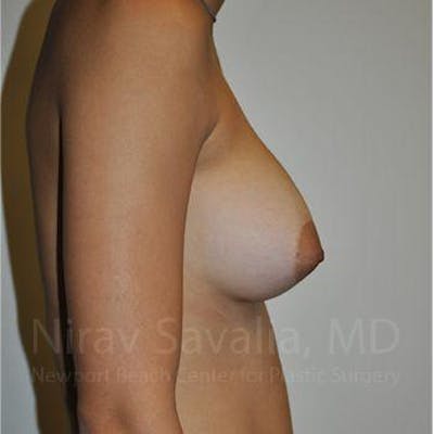 Oncoplastic Reconstruction Before & After Gallery - Patient 1655573 - After