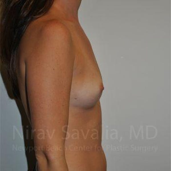 Breast Lift without Implants Before & After Gallery - Patient 1655574 - Before