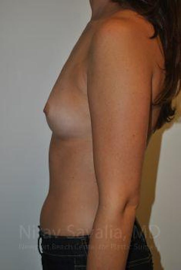 Mastectomy Reconstruction Before & After Gallery - Patient 1655574 - Before