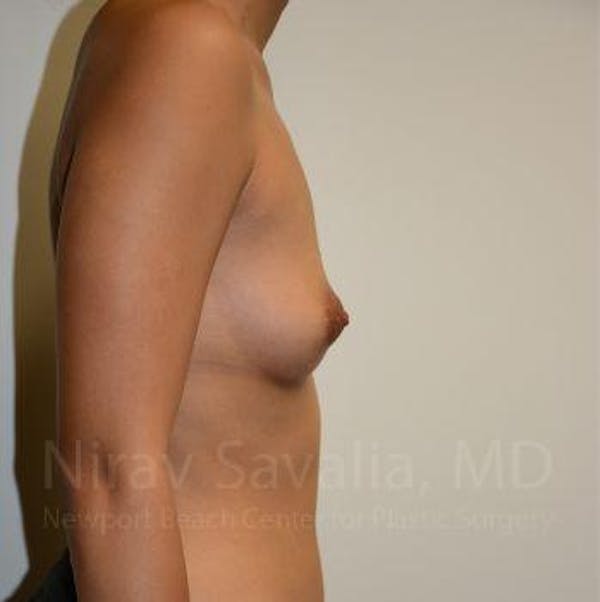 Oncoplastic Reconstruction Before & After Gallery - Patient 1655575 - Before