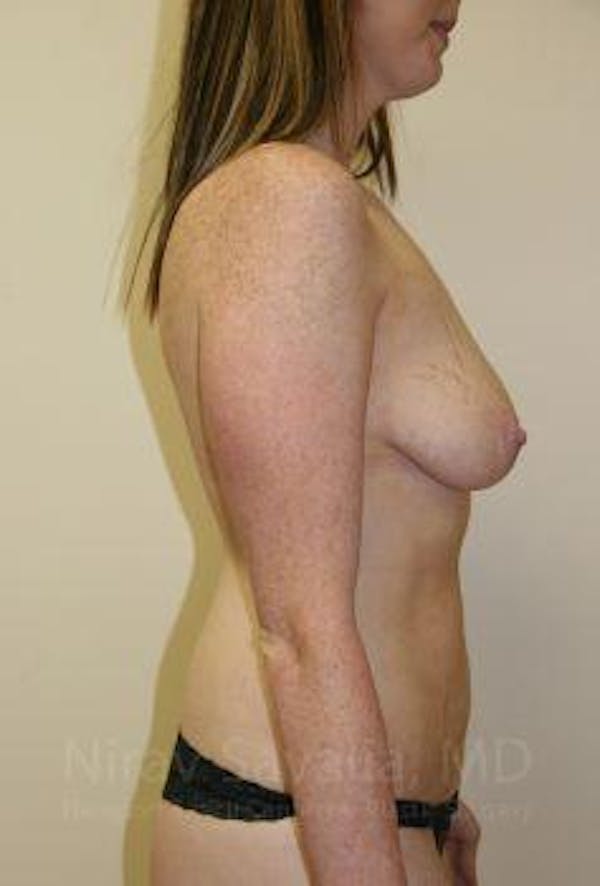Breast Lift with Implants Before & After Gallery - Patient 1655579 - Before