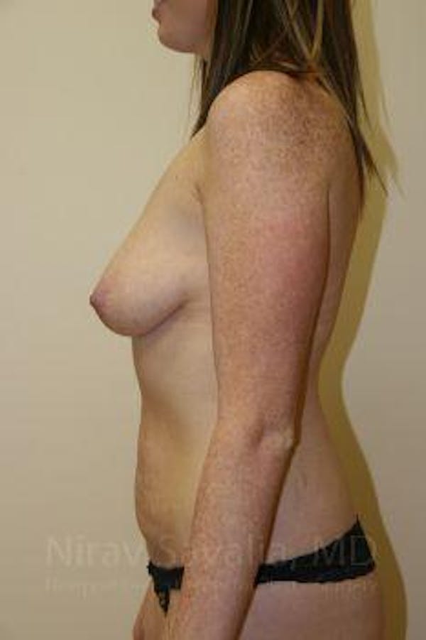 Breast Lift with Implants Before & After Gallery - Patient 1655579 - Before