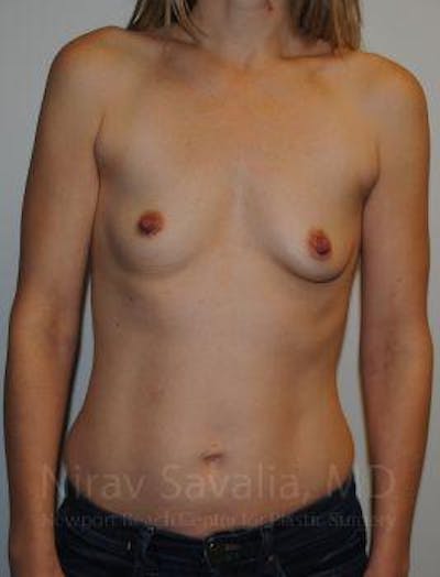 Breast Reduction Before & After Gallery - Patient 1655580 - Before