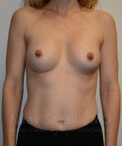 Body Contouring after Weight Loss Before & After Gallery - Patient 1655580 - After