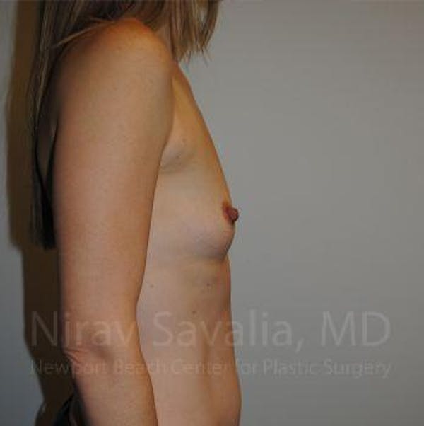 Breast Lift with Implants Before & After Gallery - Patient 1655580 - Before