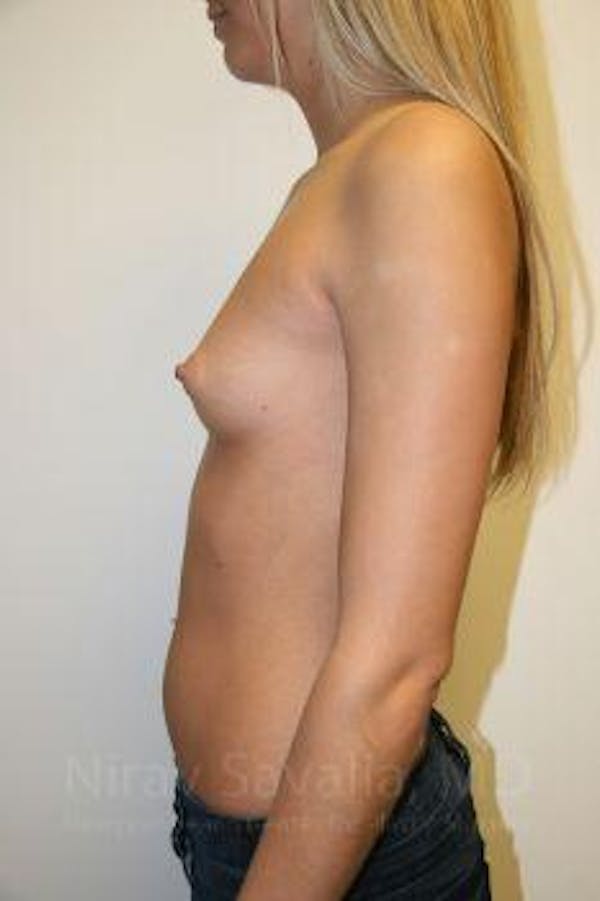Oncoplastic Reconstruction Before & After Gallery - Patient 1655581 - Before
