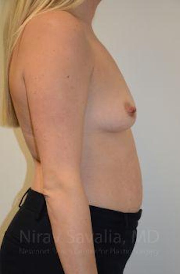 Breast Explantation En Bloc Capsulectomy Before & After Gallery - Patient 1655585 - Before