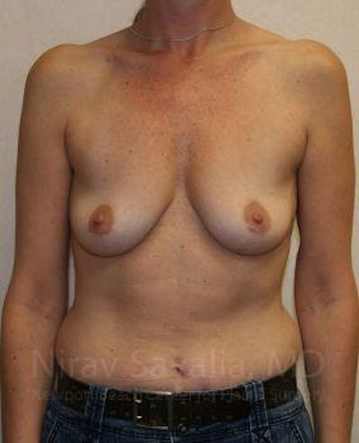 Oncoplastic Reconstruction Before & After Gallery - Patient 1655587 - Before