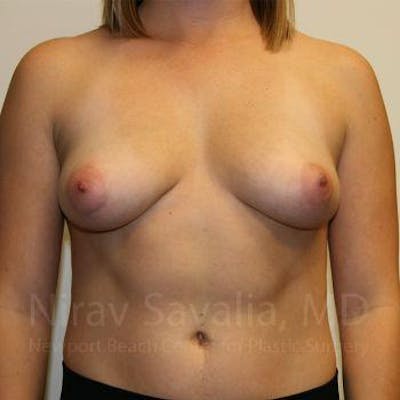 Breast Lift with Implants Before & After Gallery - Patient 1655593 - Before